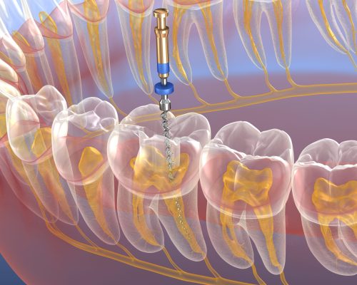 Endodontic root canal treatment process. Medically accurate tooth 3D illustration.
