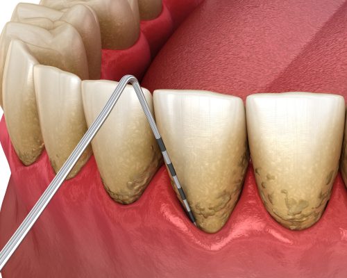 Periodontitis testing, gum recession process. Medically accurate 3D illustration